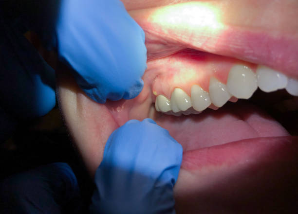 Best Emergency Dental Care for Sports Injuries in Leavenworth, KS